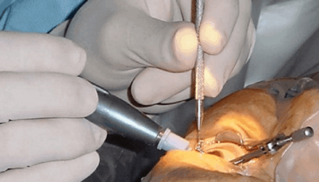 free-eye-surgery-640x366